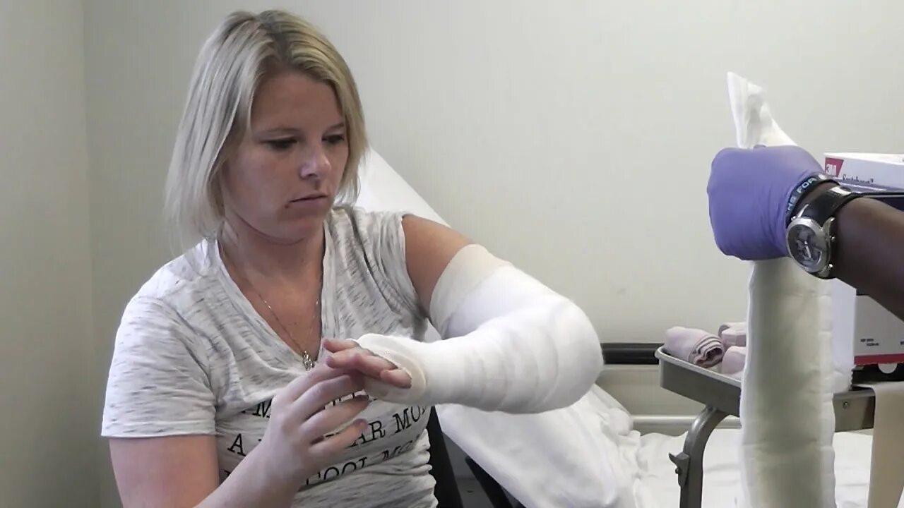 Arm casting. Arm cast lac women. double long arm cast. long arm cast woman.