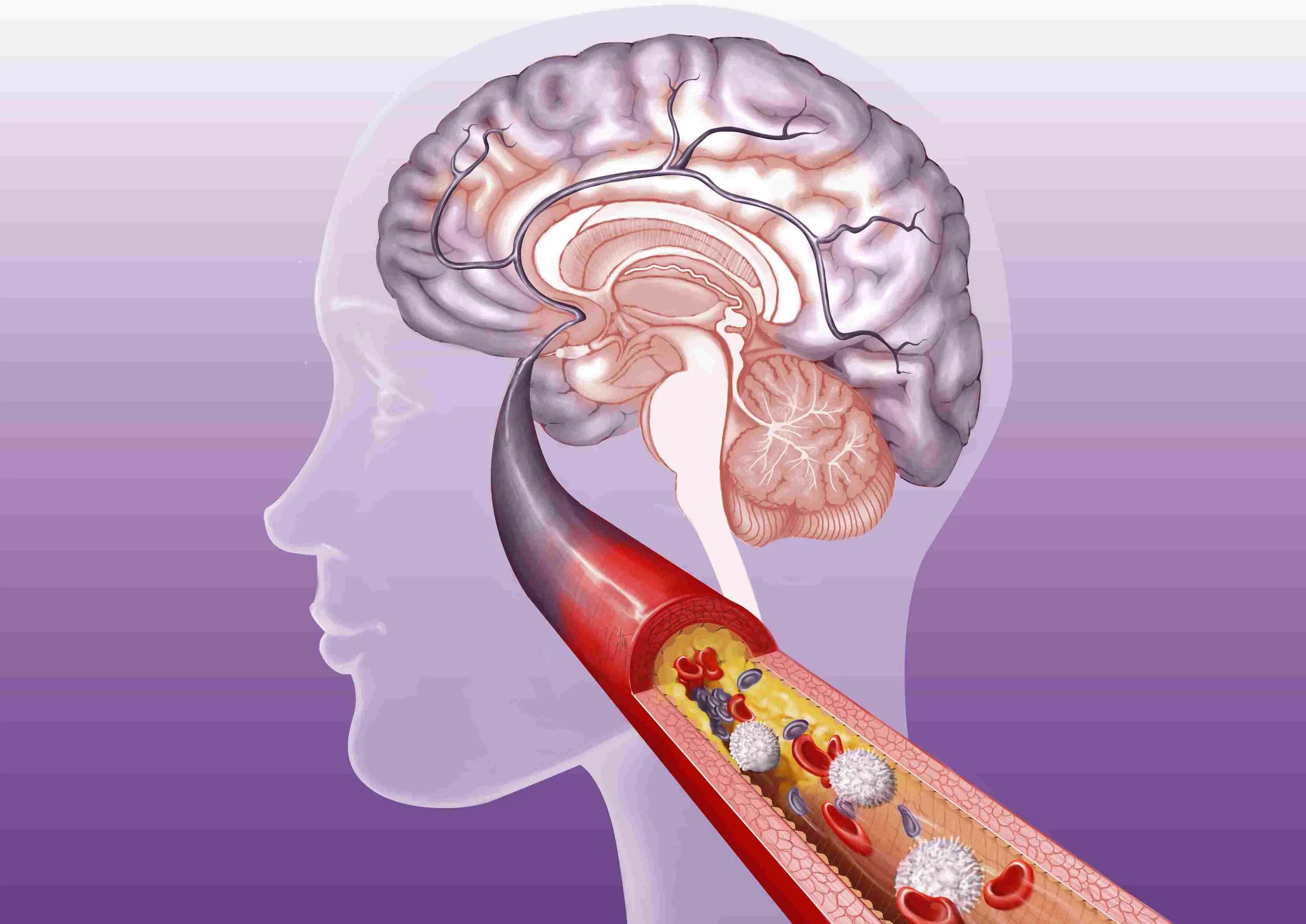 Атеросклероз сосудов головы. Тромбоз артерий мозга