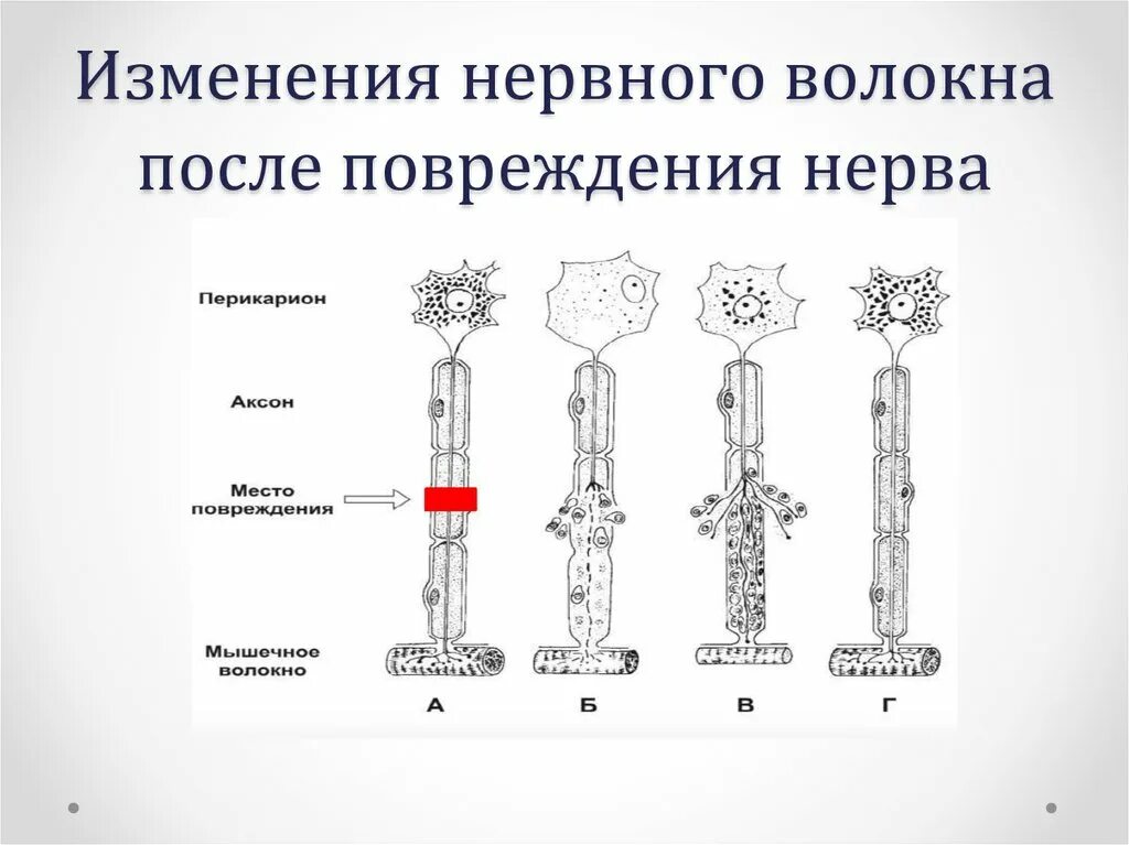 Восстановление нервов после операции. Регенерация периферических нервов. Регенерация нервных волокон после повреждения. Изменение нервного волокна после повреждения. Изменения после перерезки нервного волокна.