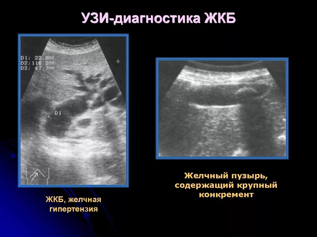 Эхогенный желчный пузырь. УЗИ желчного пузыря желчекаменная болезнь. УЗИ брюшной полости ЖКБ про. УЗИ желчного пузыря желчнокаменная болезнь.