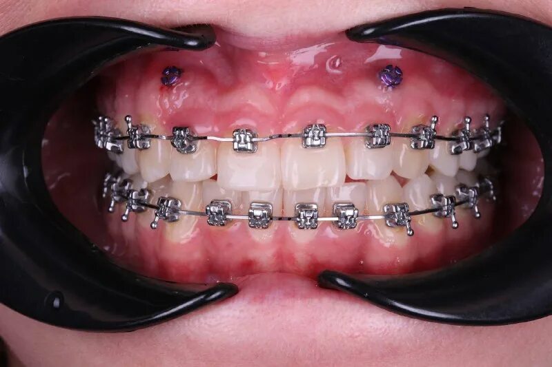 Макаревич ортодонт. Музалев максим сергеевич. Ортодонтиякский минивинты. Макаревич ортодонт. Иван макаревич 2022.