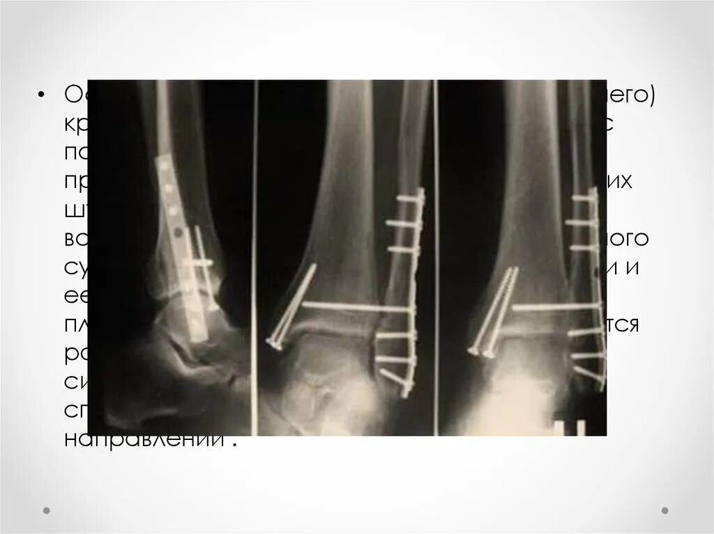 Экстрамедуллярный остеосинтез. Накостный остеосинтез голени рентген. Экстрамедуллярный остеосинтез лодыжки. Чрескостный остеосинтез лодыжки.