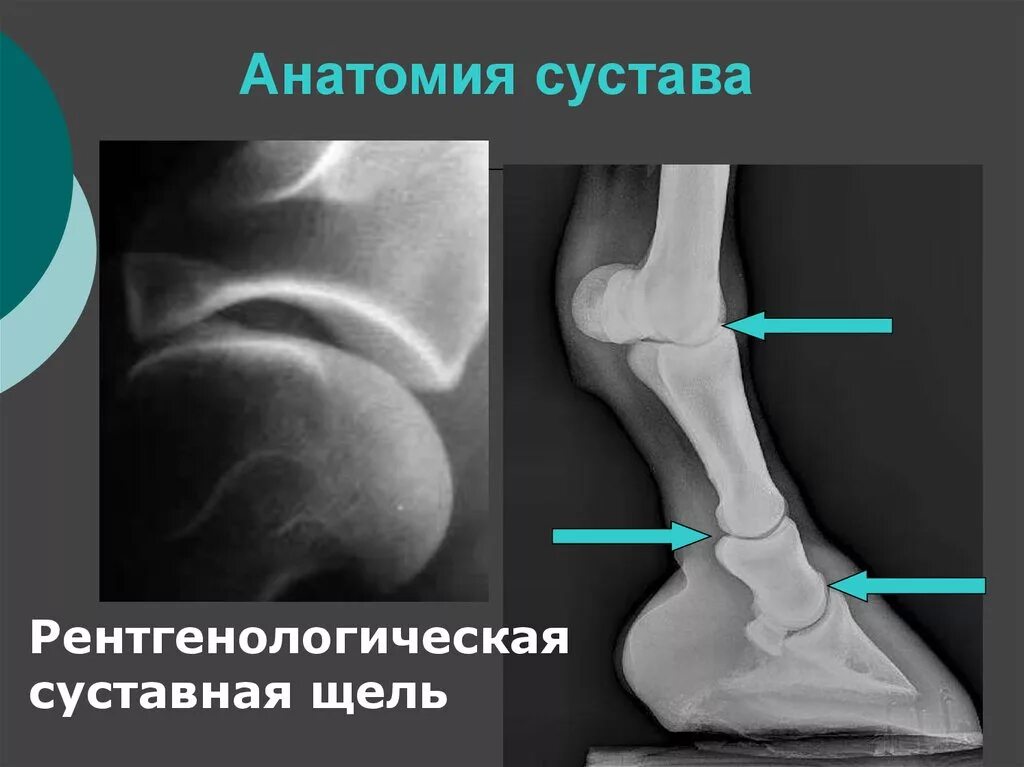 Анатомическая суставная щель. Коленный сустав рентген анатомия. Коленная суставная щель патологии.