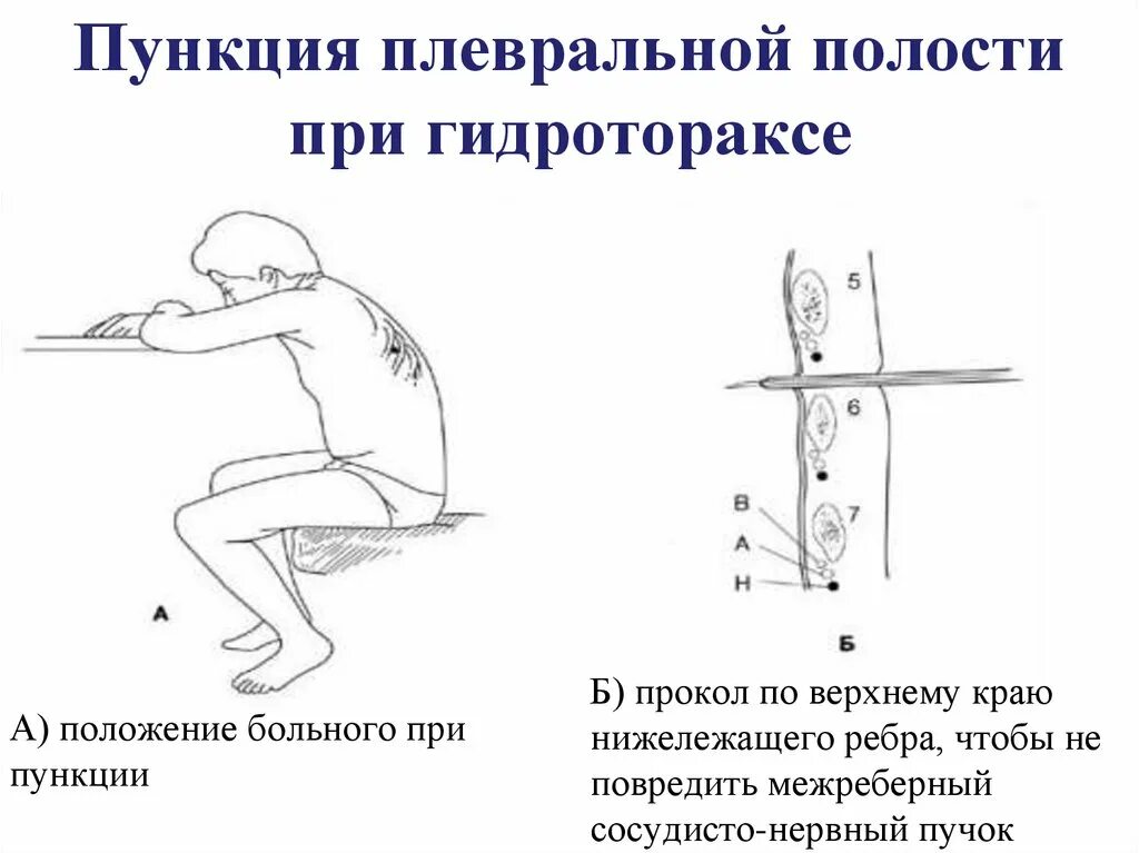 Техника выполнения плевральной пункции