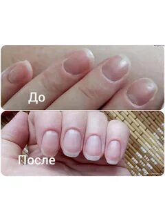 После маникюра болят