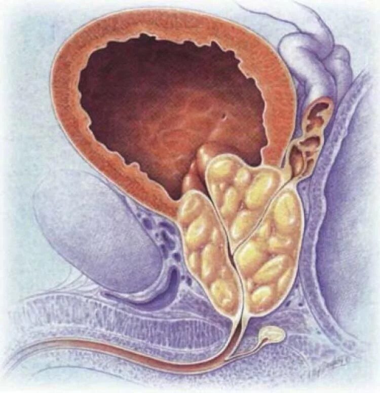 Простата крупный план. Аденома предстательной железы. Аденома предстательной железы (аденома простаты). Аденома предстательная железа у мужчин.