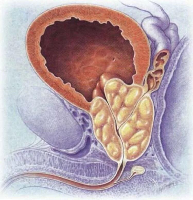 Везикулит у мужчин симптомы. Аденома предстательной железы. Аденома предстательной железы (аденома простаты). Аденома предстательная железа у мужчин.