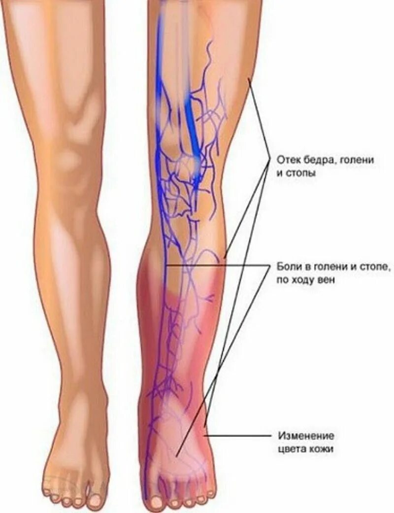 Варикозное расширение вен нижних конечностей БПВ. Тромбофлебит нижних конечностей ног. Острый тромбофлебит вены нижних конечностей. Тромбоз вен нижних конечностей схема. Став тромбы