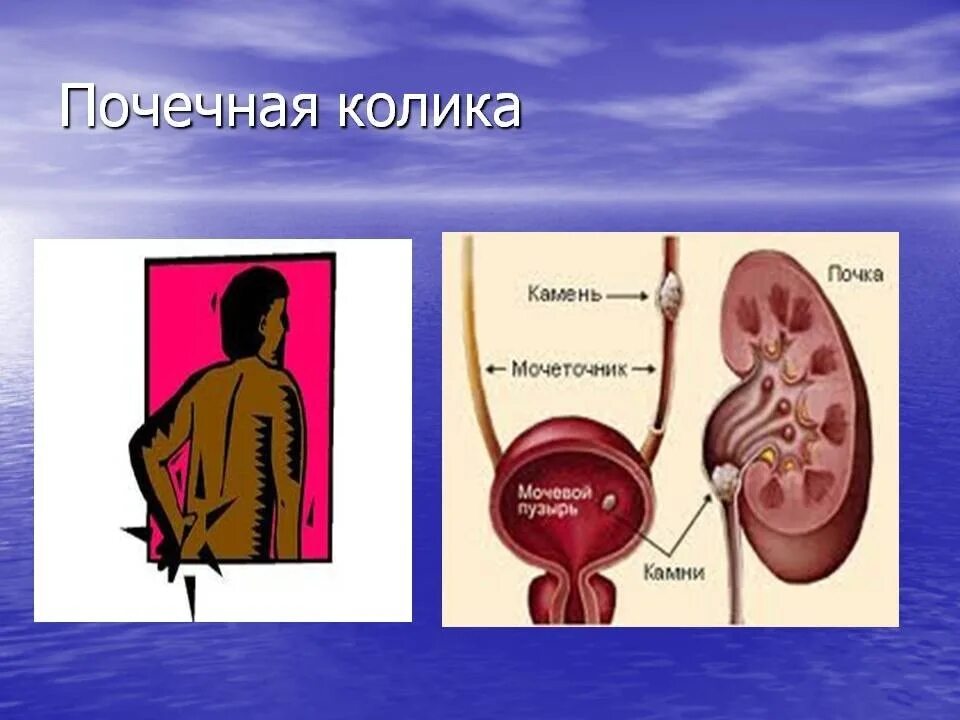 Мочекаменные колики. Почечная колика. Симптоматика почечной колики.