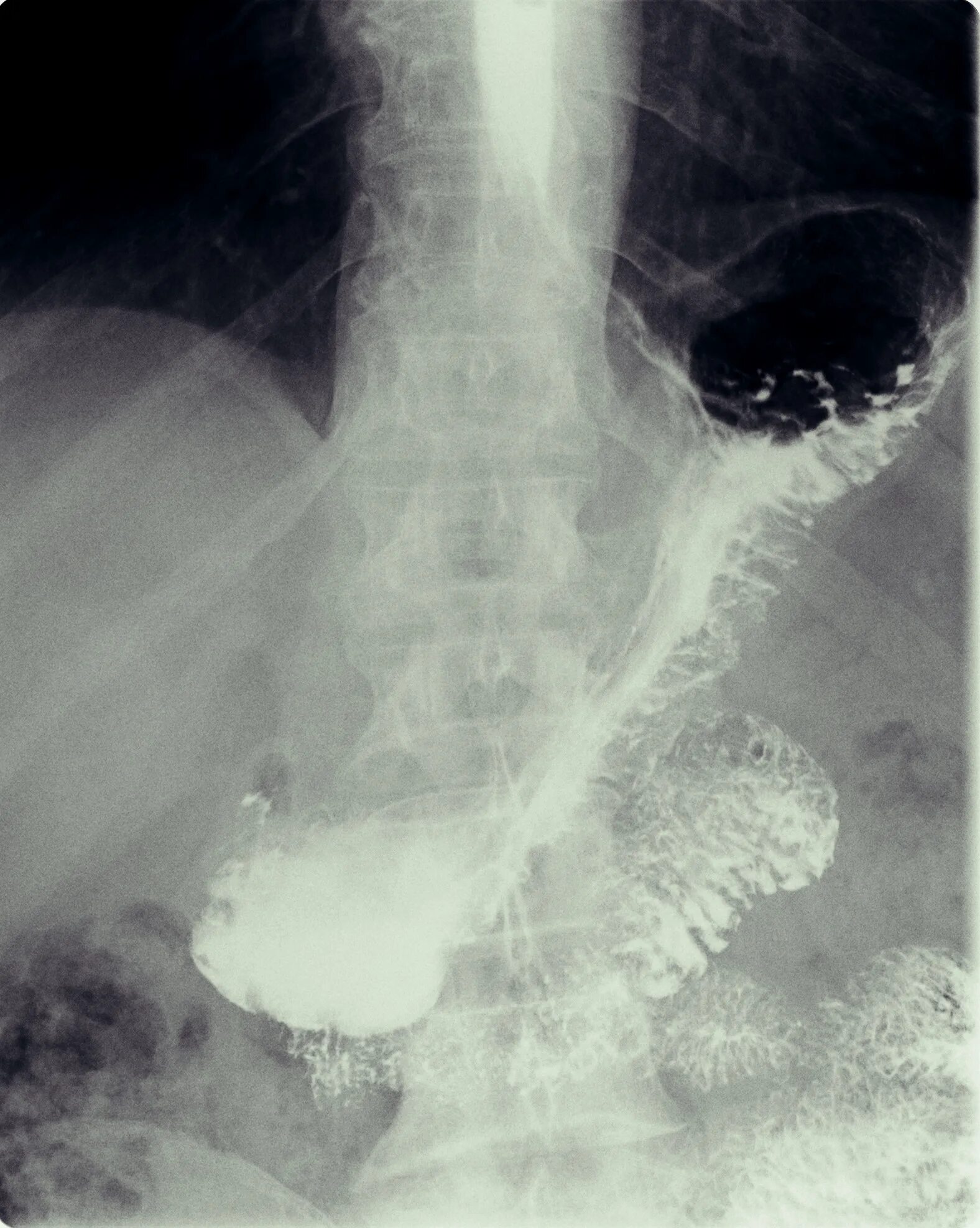 Каскад желудка рентген. Каскадная деформация желудка на рентгене. Каскадный желудок рентген. Каскадный Перегиб желудка рентген.