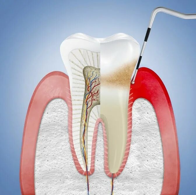 Сколько живет зуб без нерва? DentConsult Дзен