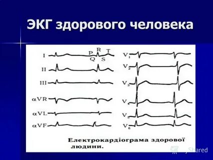 Здоровое экг