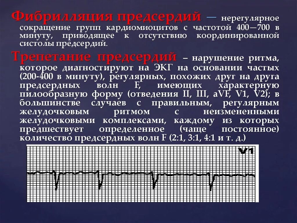 Фибрилляция и трепетание предсердий на ЭКГ. Трепетание предсердий и желудочков на ЭКГ. Фибрилляция предсердий на ЭКГ классификация. Диагноз Мерцательная аритмия фибрилляция предсердий.