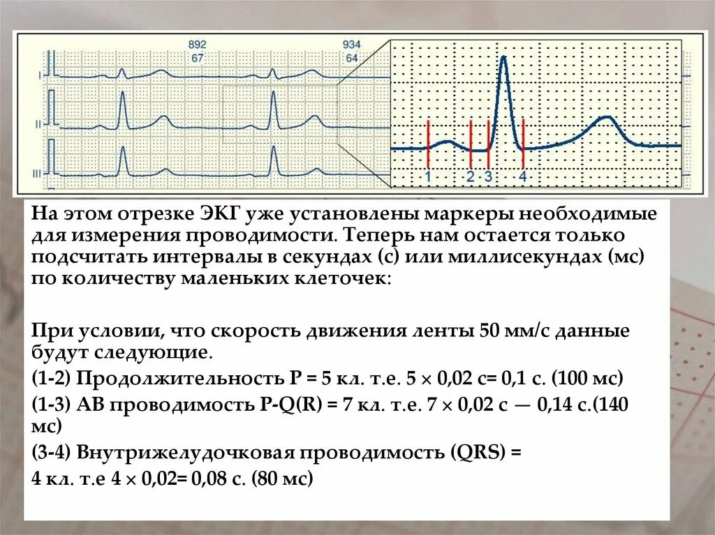 Мв на экг. Подсчёт ЧСС по ЭКГ 50 мм. ЭКГ норма 50 мм/с. Как посчитать комплекс QRS на ЭКГ. Подсчёт ЧСС по ЭКГ 25 мм.