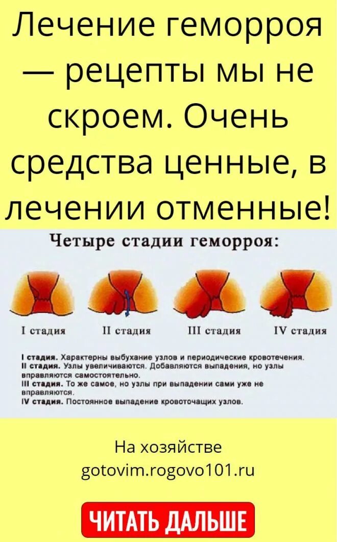 Можно вылечить геморрой навсегда. Чем лечить геморрой в домашних условиях быстро.