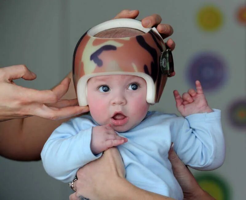 Ортопедический шлем. Шлем для коррекции черепа ребенка. Шлем для выравнивания головы у ребенка. Шлем в виде арбуза. Ортопедический шлем для младенца.