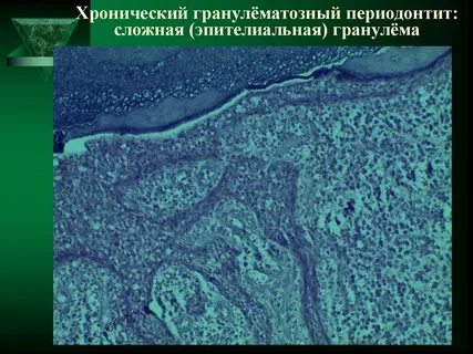 Лечение хронического фиброзного периодонтита
