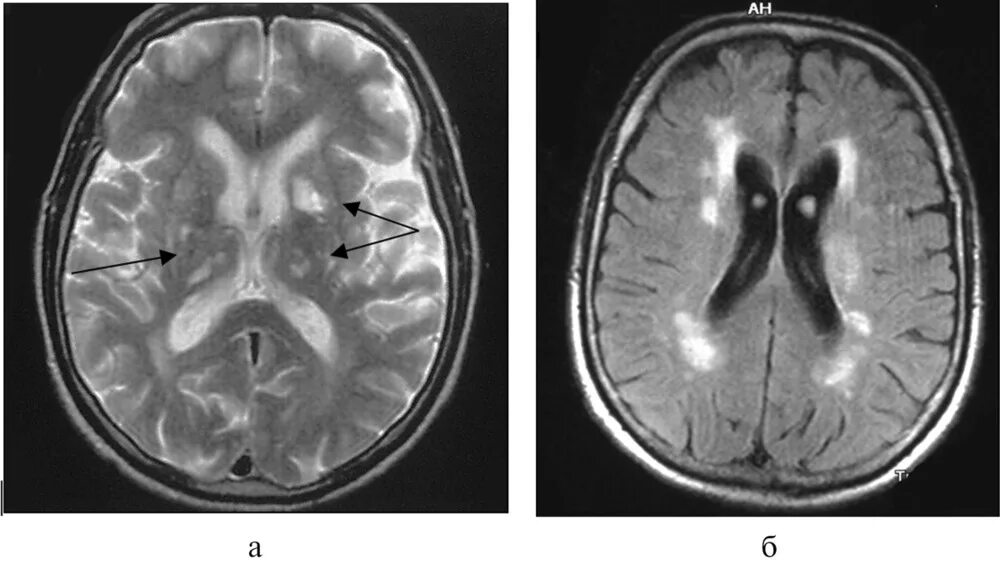 Лобарный лейкоареоз. Перивентрикулярный лейкоареоз головного мозга мрт. Лейкоареоз и гидроцефалия. Перивентрикулярный лейкоареоз на кт. Поражение белого вещества мозга