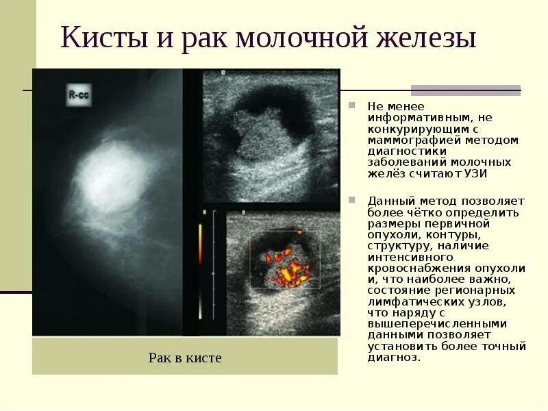 Признаки кистозных изменений. УЗИ молочных желез фиброаденома. УЗИ молочных желез фиброаденома УЗИ. Киста молочной железы с пристеночным образованием. Киста маммография снимки.