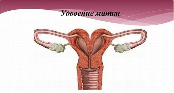 2 тела матки. Двурогая матка 2 влагалища. полное удвоение матки и влагалища. патология удвоение матки.