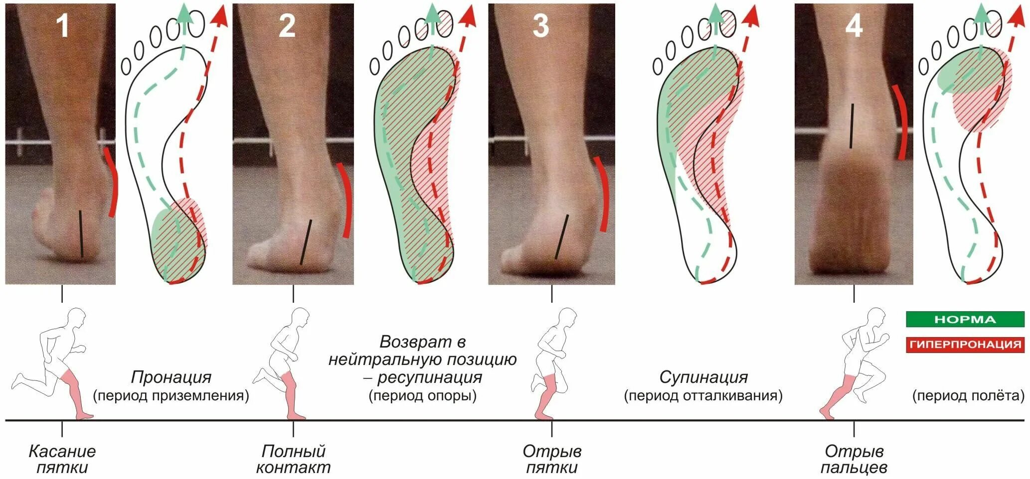 Плоскостопие пронация стопы. Пронация и супинация стопы. Кроссовки гиперпронация плоскостопие. Супинация и плоскостопие. Нога имеет ползательную подошву