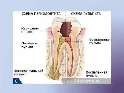 Зуб осложнения