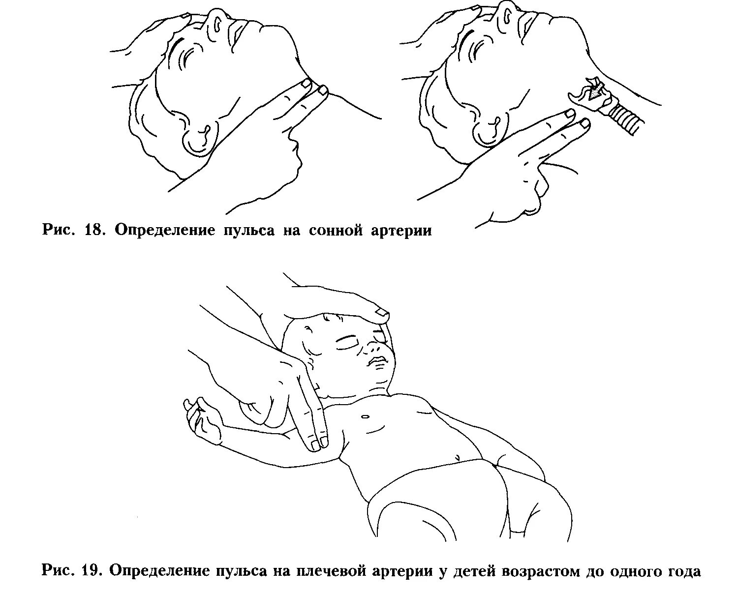 Сердцебиение у новорожденного. Измерение пульса у детей алгоритм. Измерение ЧСС У детей алгоритм. Подсчет пульса у детей алгоритм. Места измерения пульса у детей.