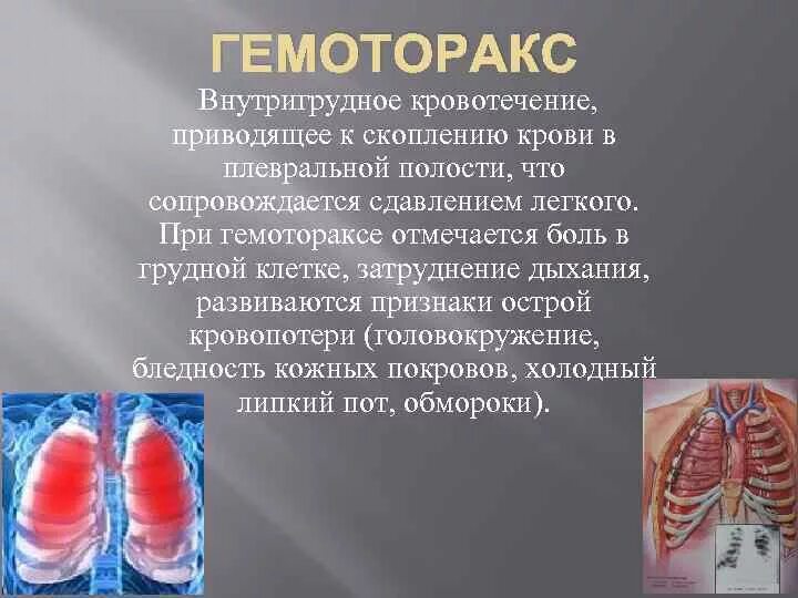 Внутригрудное кровотечение. Гемоторакс кровотечение. Кровь в плевральной полости. Наличие крови в плевральной полости