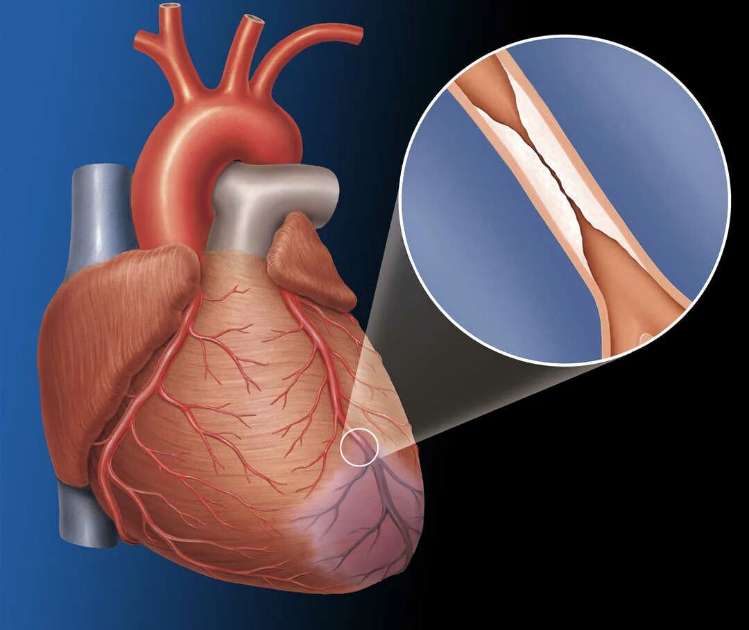 Атеросклероз сосудов сердца. Атеросклероз коронарных артерий. Атеросклероз коронарных сосудов. Закупорка артерии в сердце. Сердечная недостаточность при инфаркте миокарда