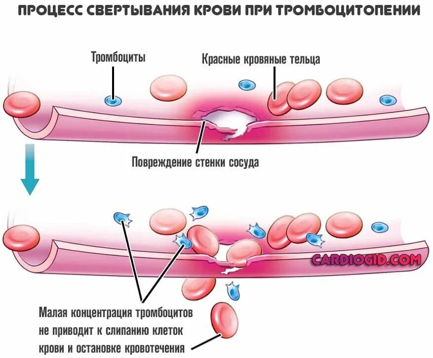 Можно ли при тромбоцитопении. Процесс свертывания крови при тромбоцитопении. нарушение свертываемости крови тромбоцитопения. иммунная тромбоцитопения сыпь. наоузение свёртываемости крови.