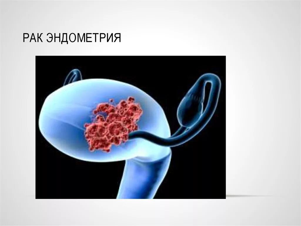 Новообразование эндометрия. Онкология презентация. Онкология эндометрия симптомы.