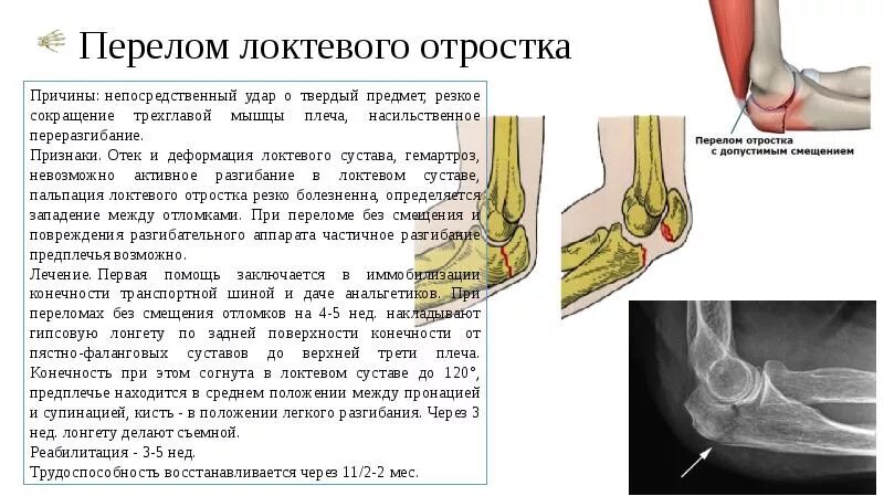 Перелом локтевого сустава симптомы. Закрытый перелом отростка локтевой кости со смещением. Перелом локтевого отростка локтевой кости рентген. Перелом локтевого отростка гипсовая иммобилизация.