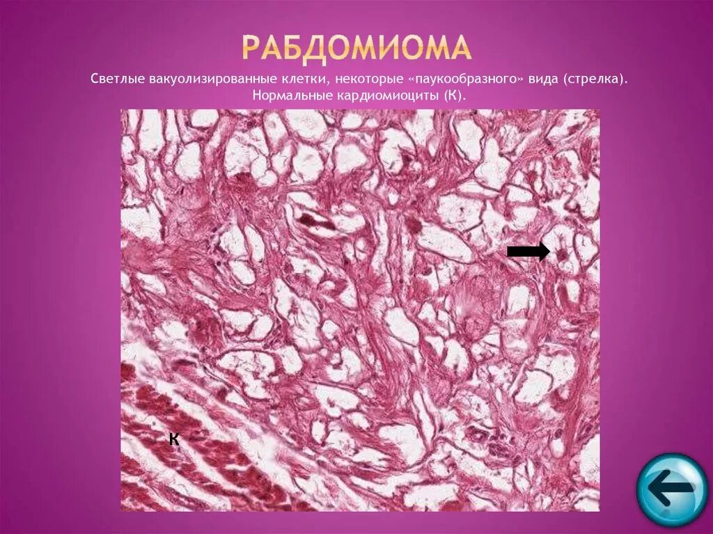 Злокачественные опухоли сердца. Рабдомиома гистология. Рабдомиома мягких тканей. Рабдомиосаркома гистология патанатомия. Липома молочной железы на узи.