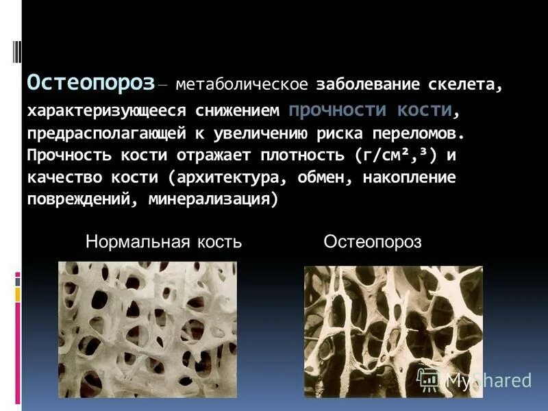 остеопороз реферат. структура костной ткани порозно разрежена. системное поражение костей скелета. структура кости при остеопорозе. системные заболевания костной ткани.