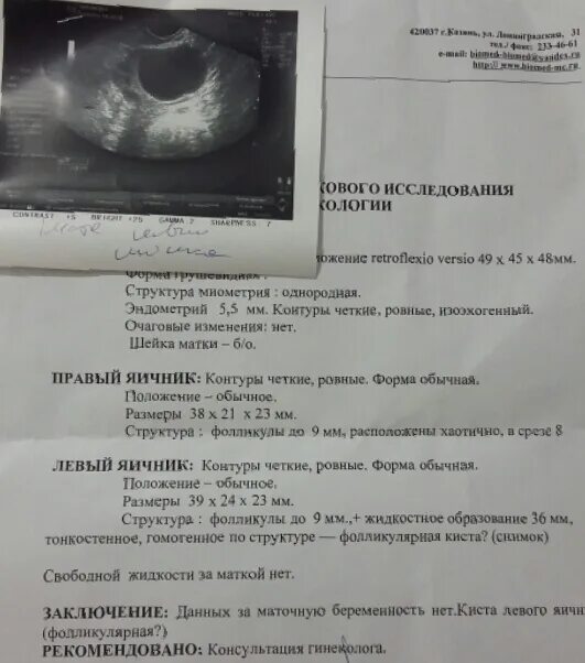 Задержка месячных при кисте яичника