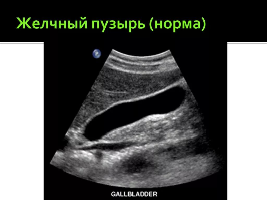 Сонограмма желчного пузыря. Сонограмма желчного пузыря в норме. Сонография желчного пузыря. Желчные протоки на УЗИ норма. Норма желчного пузыря у мужчин