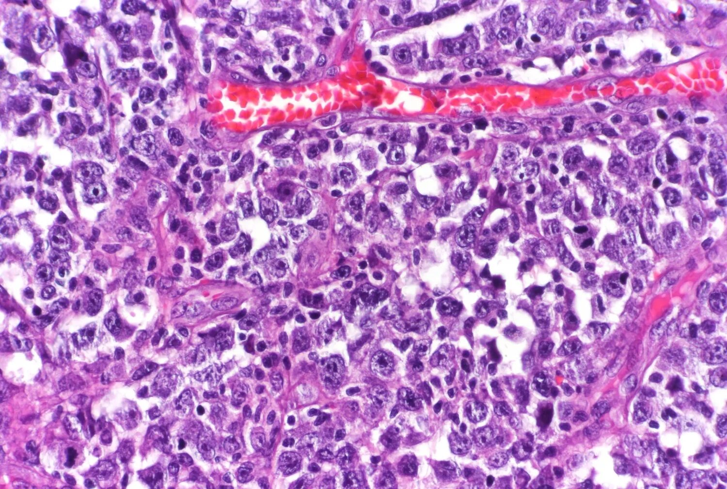 Large cell lymphoma. Крупноклеточная лимфома гистология. Лимфосаркома патанатомия. Лимфома ходжкина гистология. Large cell lymphoma.
