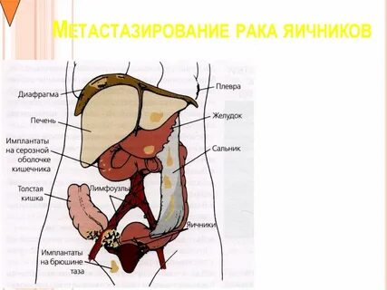 Рак яичников метастазы
