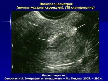 Полип в матке на узи симптомы
