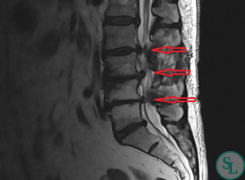 Поясничный абсолютный стеноз. Сагиттальный стеноз позвоночного канала л4-с1. Стеноз l3-l5. Стеноз позвоночного канала l4-s1. Стеноз позвоночного канала поясничного отдела мрт.