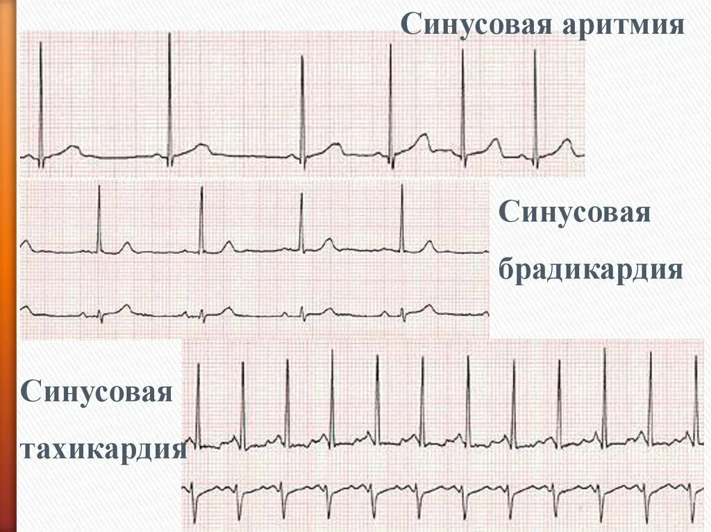 Синусовая тахикардия вертикальное. Синусовая брадикардия с синусовой аритмией. Синусовая аритмия на ЭКГ. Синусовая брадикардия на ЭКГ. ЭКГ синусовая тахикардия брадикардия аритмия.