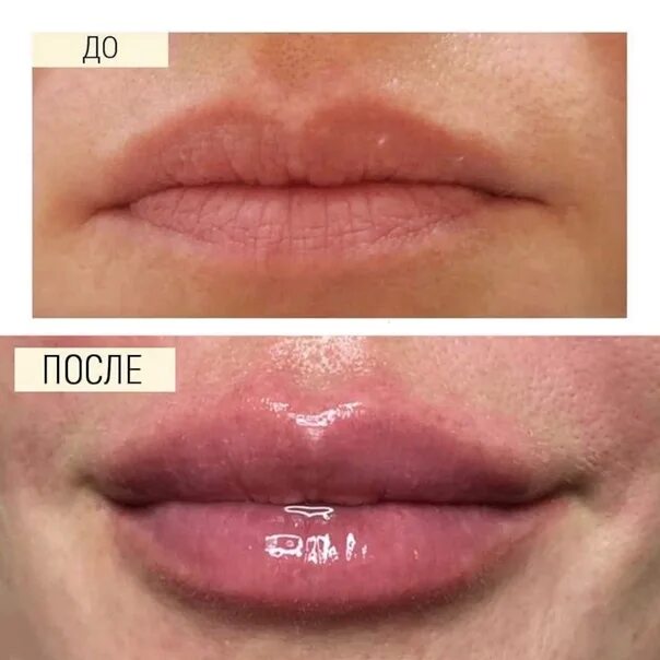 В собственно коже отсутствует пигмент. Протокол коррекции губ. Корректировка губы лонгидазой.