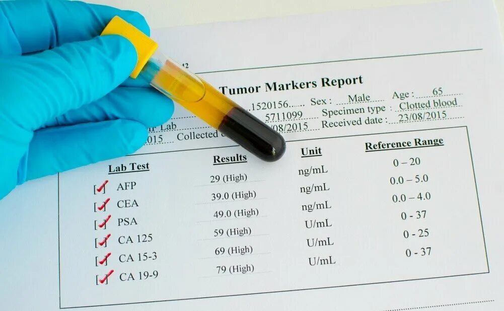 Онкомаркеры пса. Тест на онкомаркеры. Кровь на онкомаркеры. Онкомаркер пса норма. Кровь на 15 3