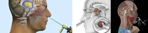 Удаление гипофиза операция