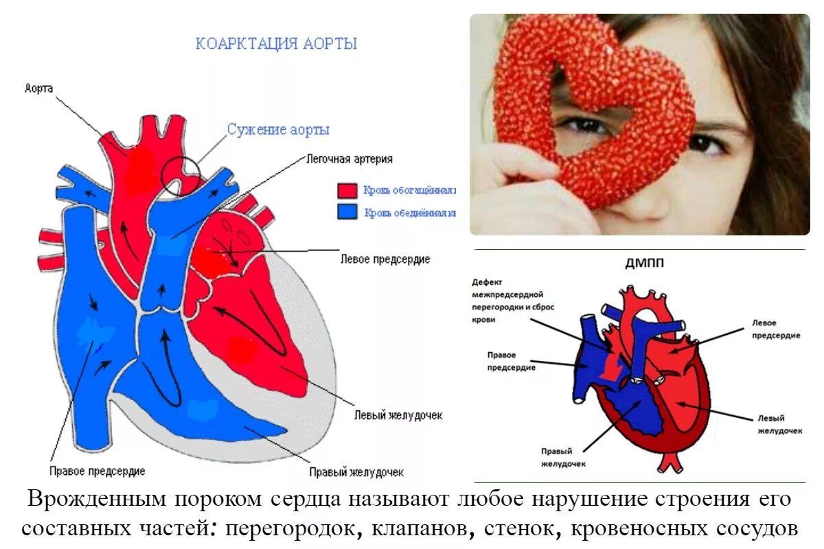 Врожденный порог Серда. Схемы врожденных пороков сердца. Врожденные пороки сердца у детей.