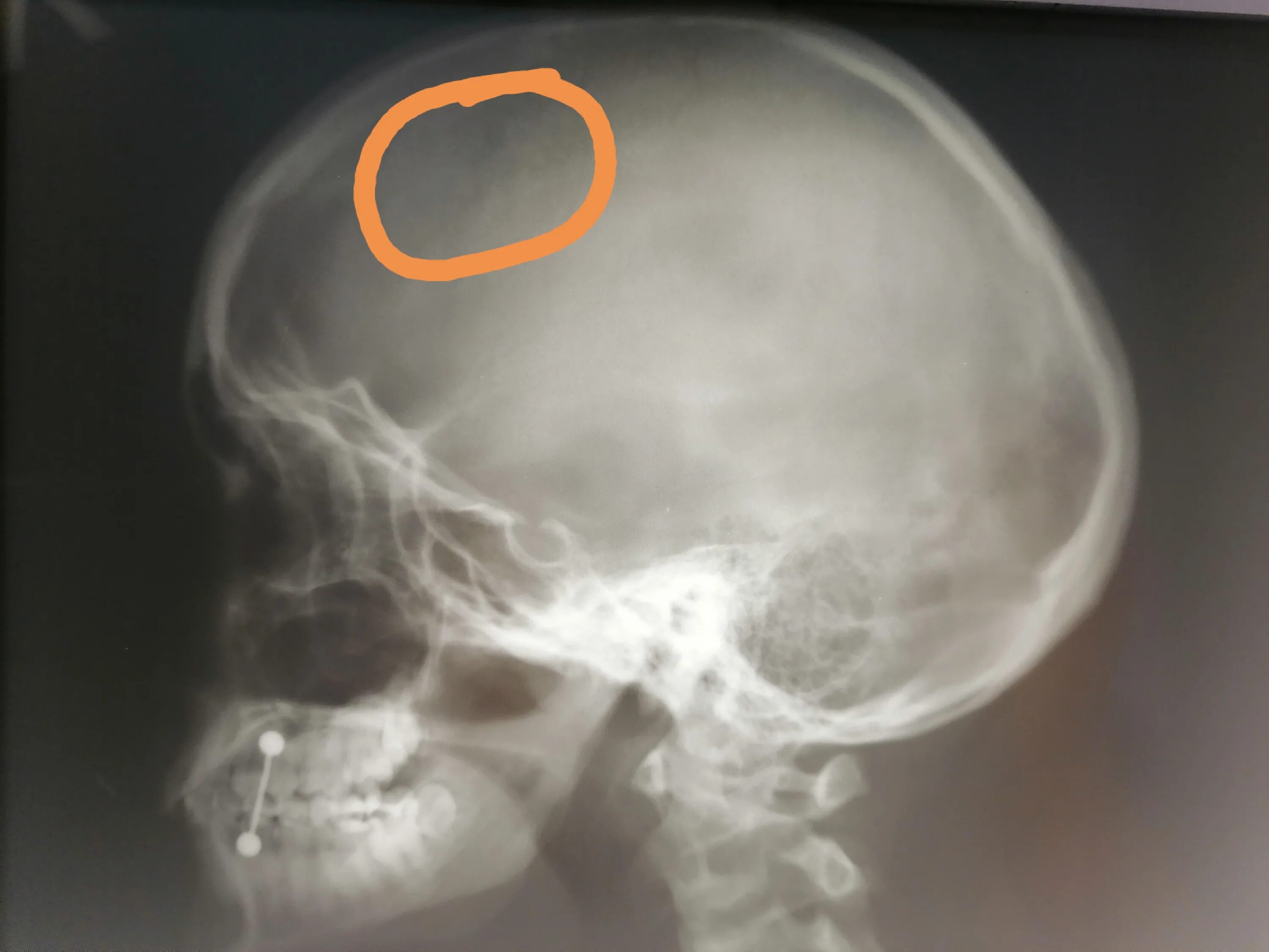 Трещина в голове. Кости черепа рентген норма. Обзорная рентгенограмма черепа. Рентгенограмма черепа ребенка.