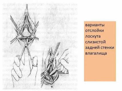 Манчестерская операция в гинекологии