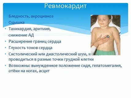 Ревмокардит