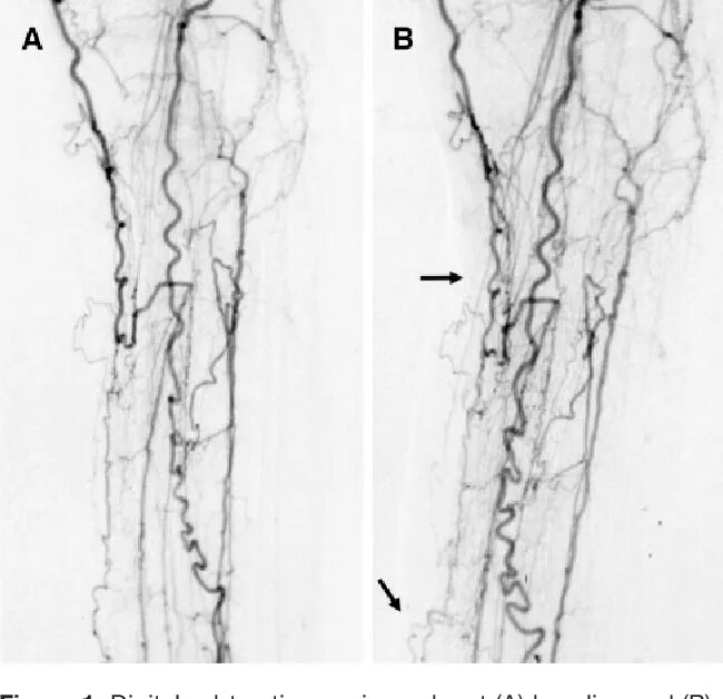 Атеросклероз нижних конечностей клиника. Атеросклероз окклюзия нижних конечностей. Атеросклероз окклюзия нижних конечностей. Атеросклероз окклюзия нижних конечностей. Облитерирующий атеросклероз ангиография.