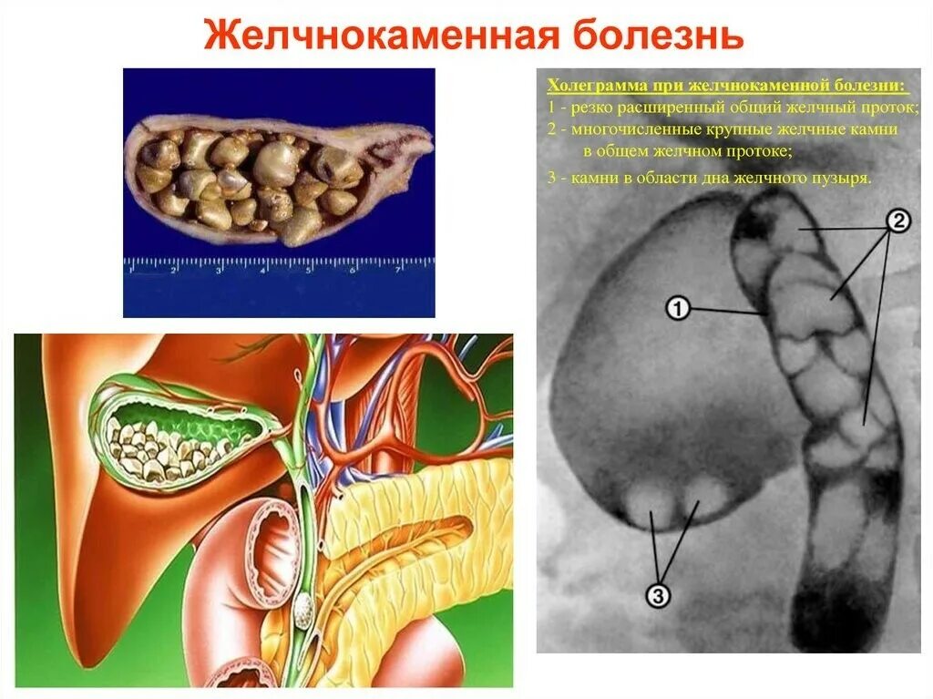 Какие симптомы при камнях в желчном